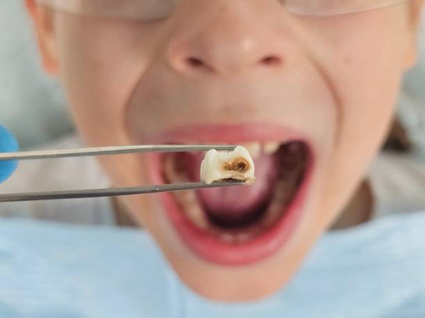 Best Emergency Tooth Extraction in Strawberry Point, IA